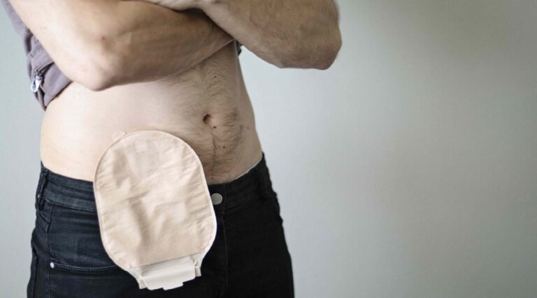 Stomabeutel Wechseln In Einfachen Schritten Erklärt Und Gezeigt Stomaversorgung wechseln - So einfach gehts